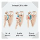 연세대학교의과대학세브란스병원 | 방카르트 어깨 수술 통증? 병원 가야 합니다.