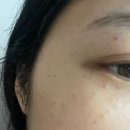 123한의원 | ‘인천 한의원 거우침’ 비립종, 편평사마귀 148개 제거 내돈내산