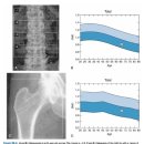 골다공증(Osteoporosis)의 원인, 검사와 진단 이미지