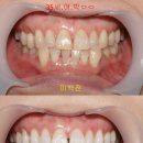이사랑치과 네이버블로그