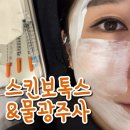 뷰티온의원 파주운정점 | 파주 스킨보톡스 당일시술 마취부터 통증 비용 멍 붓기 까지 리얼 후기
