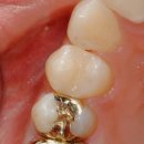 애프터기공소 이미지