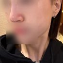 강남역 코프팅 코실리프팅 비너스코 두번째 재시술 솔직후기(전후비교, 유지기간, 리터치)
