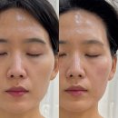 센텀동로 | 해운대에스테틱 신부관리 추천 페이슬림 알테온 리프팅 관리 후기