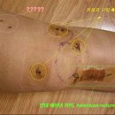 [sean's 수술전후정보 3탄]전방십자인대 자가건 수술 자국 이미지