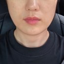 세븐페이스 | 창원피부과 시티세븐 튠페이스 리프팅 후기 (팔자주름,턱선 한번에 해결)