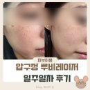 루비레이저 압구정 성형외과 의원 내돈내산 후기 2탄