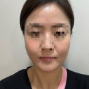 레이져 | 40대 내돈내산 피부관리3차,신형 에일린 레이져 효과와통증 솔직후기