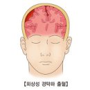 외상성 경막하 출혈 (Traumatic subdural hemorrhage) 이미지