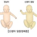 황달 원인 및 과 관리방법 알고가세요 이미지