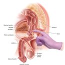 전립선비대증 이미지