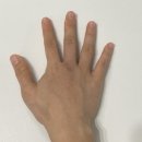 광명성애병원 | 수지접합전문 광명성애병원 수부외과 수술후기