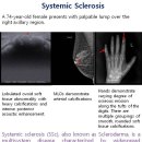 Systemic Sclerosis 이미지