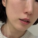 리즈 | 대구 동성로 피부과 스킨보톡스 리쥬란 HB 리즈네 효과 통증 후기