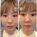 포레스트성형외과 | [압구정성형외과]포레스트리프팅 팔자주름 없애기(필러x)팔자 제거 후기