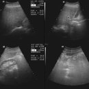 Abdomen 실제 초음파 이미지