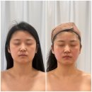 V라인S라인 | [양평피부관리] 뼈 깎는 고통 없이 V라인 완성 리즈결 에스테틱 중안부 축소 후기