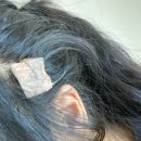 신윤석외과의원 | 두피섬유종 제거 수술 받은 후기 (서귀포 병원 추천)