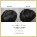 일러스라인 | 신림동 근처 탈모 치료로 유명한 '일러스라인'에서 smp 시술 ! 효과 최고