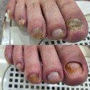 문제성발톱, 발톱무좀관리 다락방