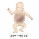 선천성 소장 결손, 폐쇄 및 협착[Congenital absence, atresia and stenosis of intestine] 이미지