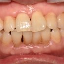 강동본치과의원 | 강동구 굽은다리역치과 잇몸뼈이식임플란트, 언제 필요할까요?