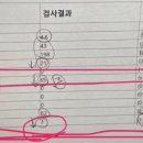 [색전술수술후기]정자1프로의 정계정맥수술 찐 내돈내산 후기!! (수술 3개월 전후 결과 공개)