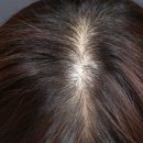 월랑초등학교 | 아산탈모병원 후기｜40대 여성 정수리·가르마 탈모치료 기록