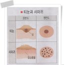 티문