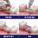 미소핀의원 | 수원 뼈이식 임플란트 ,뼈가 부족하면 임플란트 못 한다?