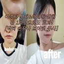 브이의원 | 닥터손유나의원 브이캣 얼굴윤곽주사 단 1회만으로도 톡톡한 효과!