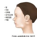 길랑바레증후군 길랑 바레 증후군 원인 법 이미지