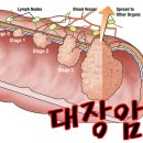 대장암 증상 '변비해소법' 이미지