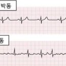 심장이 빨리뛸때 갑자기 두근거림 원인 증상 아시나요 이미지