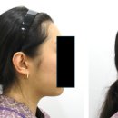 씨엘피부과의원 | 턱지방흡입, 성공하는 사람들만 알고 있었던 2가지