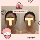 용산-6 | 용산에스테틱 45도 광대축소 위뷰티 6회 실제 후기