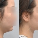방이정형외과의원 | 이중턱, 만져보면 원인이 보입니다 -21성형외과가 4가지로 나누는 이유