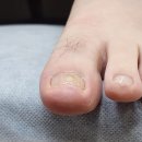 삼송상쾌한이비인후과의원 | 덕양구 삼송 지축내성발톱 무좀 아프지 않게 해결한 후기