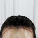 라인1차 | 명동두피관리 추천 콤마더문 명동점 여자 헤어라인·정수리 SMP시술 1차 리얼후기
