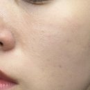 수원시 팔달구 중부대로 | 수원 여드름관리 더라르떼 수원 3번째 재방문 솔직 후기 1:1 맞춤케어