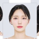 사각턱 치료[square jaw reduction] 이미지