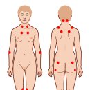 섬유근육통[fibromyalgia] 이미지