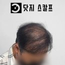 정수리 이미지