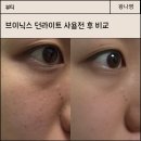 브이닉스 던라이트, 피부진정에 도움을 주는 피부샵 디바이스 추천후기
