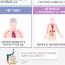 심부전 및 원인과 : 울혈성 심부전증 이미지