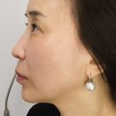 40 | 강남 청담 피부과 튠페이스 후기 통증 40대리프팅 추천