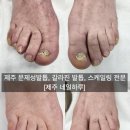 문제성 손발톱 전문관리 케어톱톱
