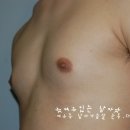 여성형유방 (여유증) 과연 다이어트로 가능할까? 이미지