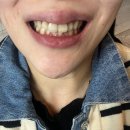 통영이플란트치과의원 | 강남역 교정치과 뉴엔치과교정 3개월9개월 리얼 후기 와이어 교체 + 고무줄 시작