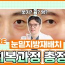 17년차 성형외과 전문의가 알려주는 눈밑지 회복 꿀팁 #눈밑지 #눈밑지방재배치 #눈밑지회복기간 이미지